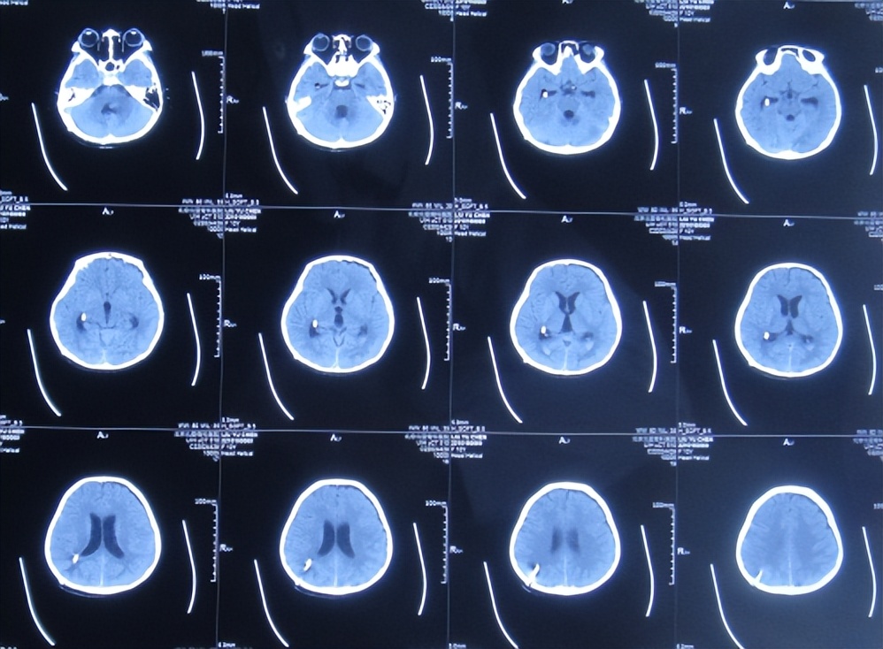 脑干出血儿童,儿童脑干胶质瘤呕吐