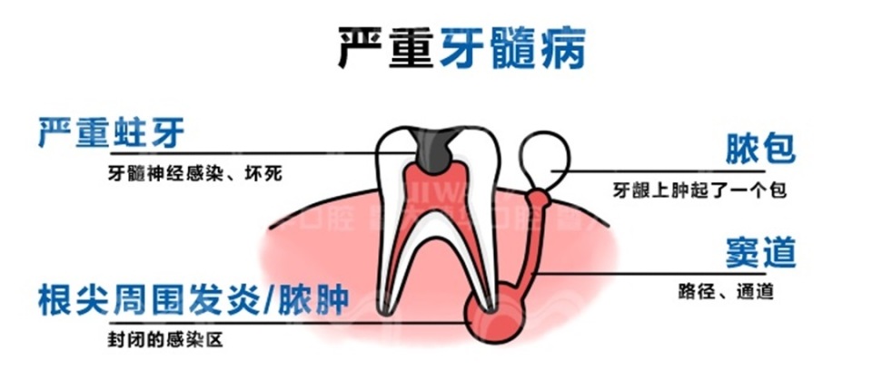 牙疼怎么辨别是哪种牙病,牙疼怎么判断是上火还是有炎症