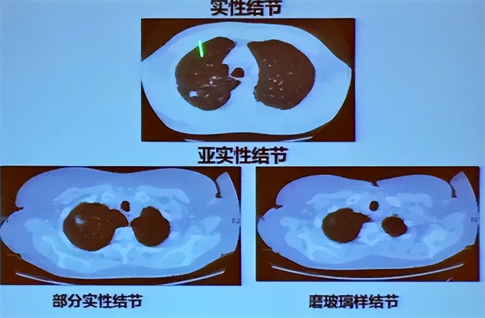 查出6mm肺结节半年结节逐渐消失,60岁大姐肺有个小结节需要治疗吗