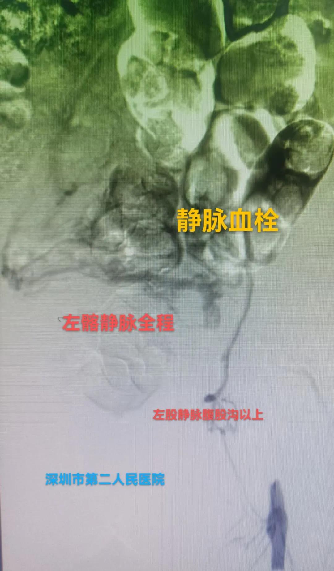 一到下午就腿肿什么原因怎么治疗,腿肿是什么病的前兆怎么治疗