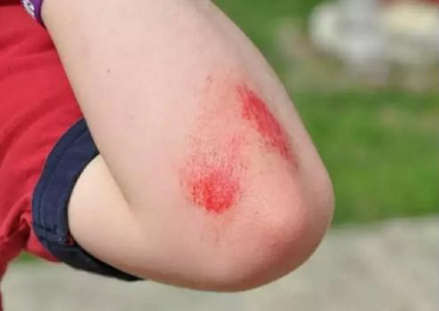 孩子磕碰到怎么安慰,小孩子划伤后有痕怎么处理