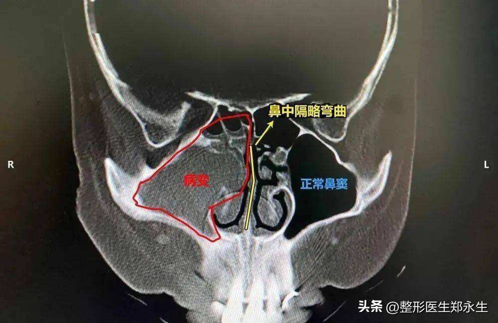 鼻中隔偏曲矫正三大误解：自我矫正、徒手正骨和吃药改善