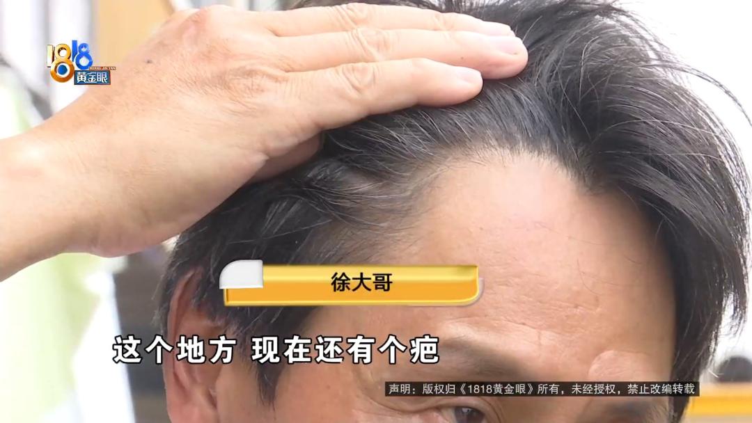 舒舒服服吃完饭，天降石膏板砸头上