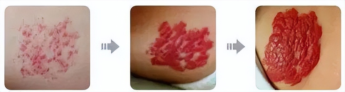 肝上面长了个血管瘤需要怎么处理,宝宝长了血管瘤怎么办