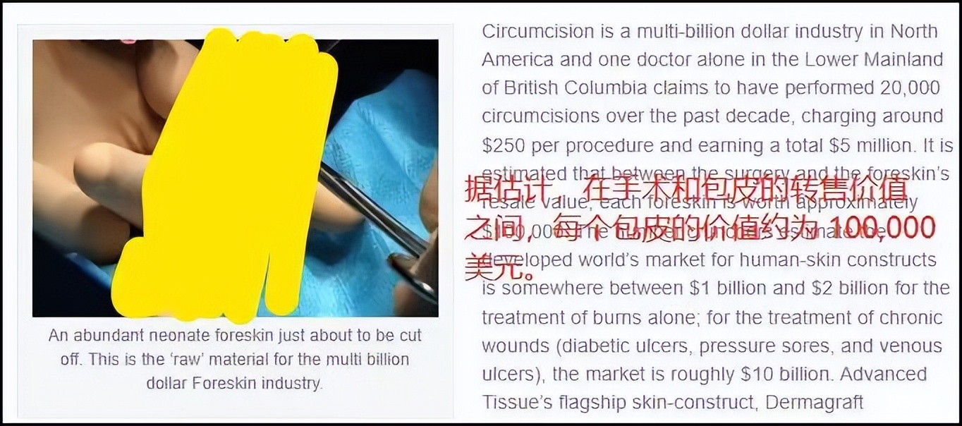 被割下的包皮,被割的包皮