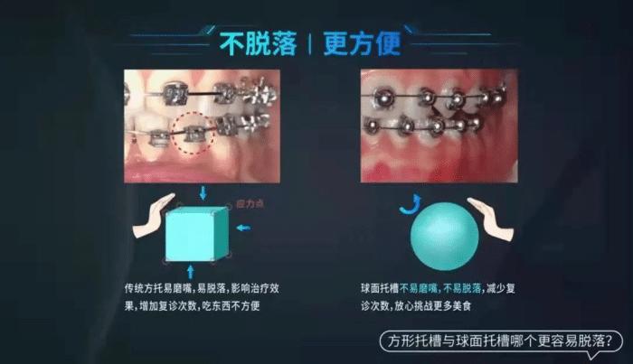 球托牙套,牙套很容易掉怎么办