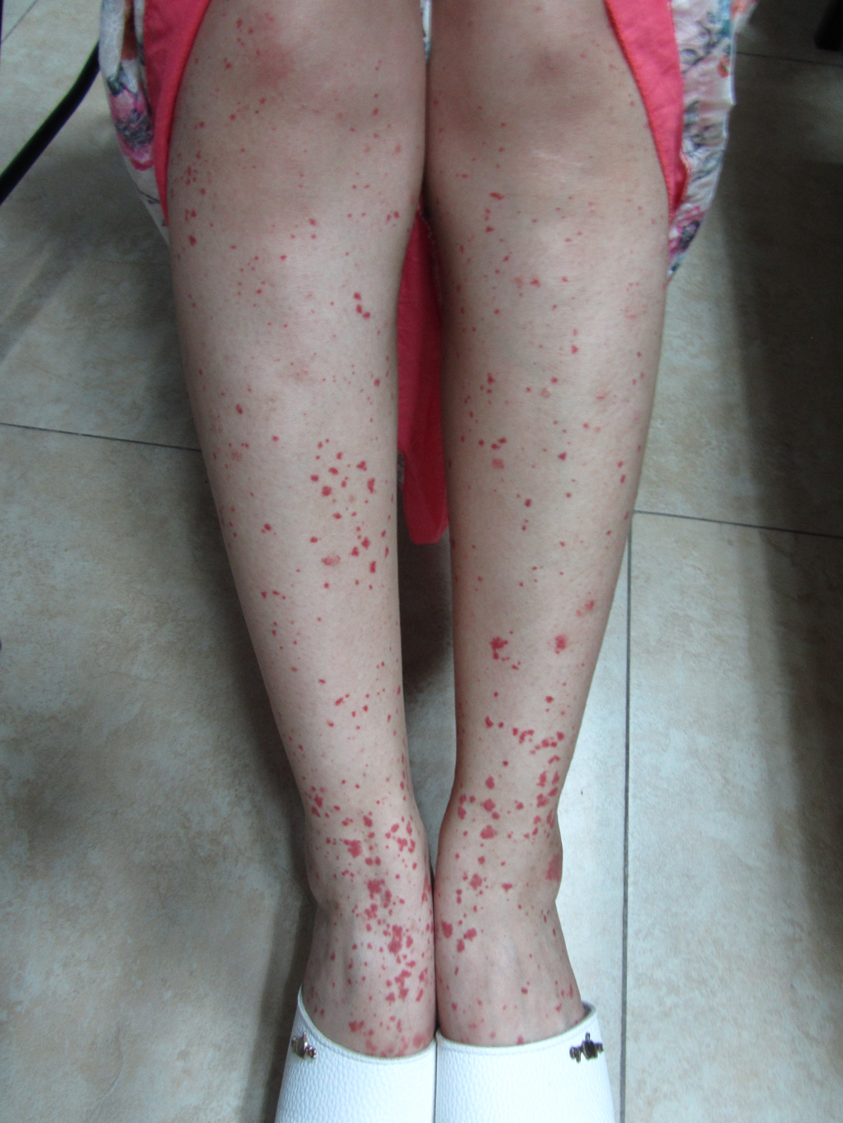 儿科过敏性紫癜个案护理范文,儿童过敏性紫癜护理问题及措施