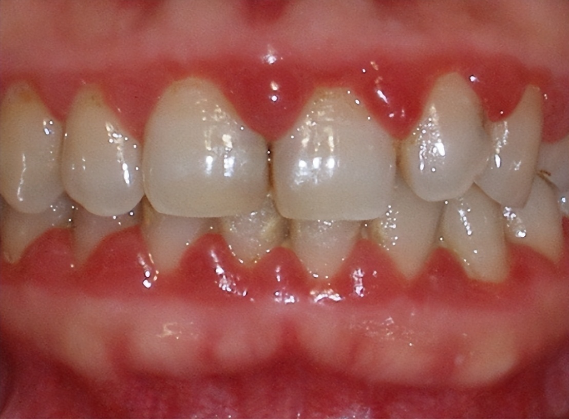 牙龈纤维瘤是肿瘤吗,牙龈纤维瘤会遗传给下一代吗