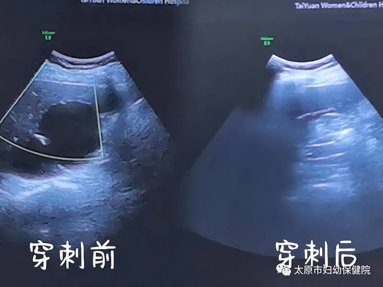 太原市妇幼保健院完成首例超声引导下经皮肝囊肿穿刺硬化术