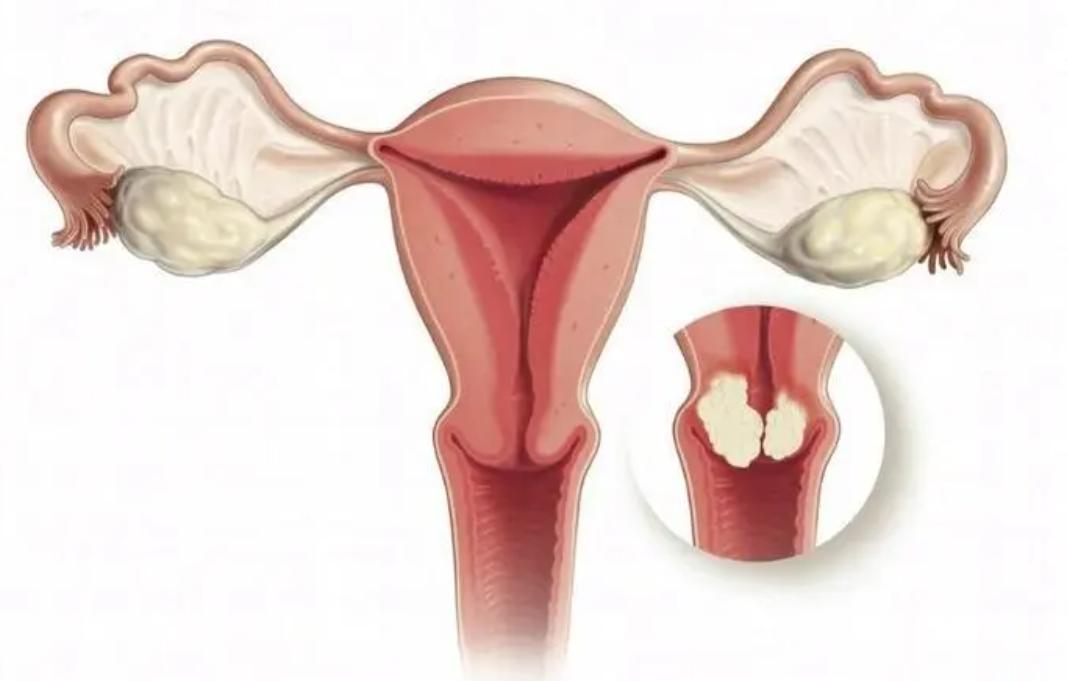 绝经几十年突然来月经什么情况,女性绝经后要小心3种情况找上门