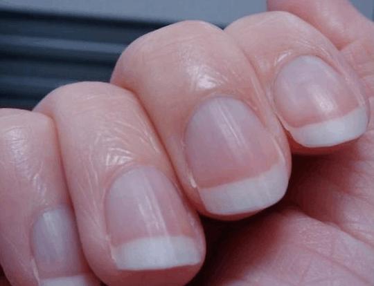 手指甲为什么会出现问题,手指甲和脚指甲有竖纹怎么回事