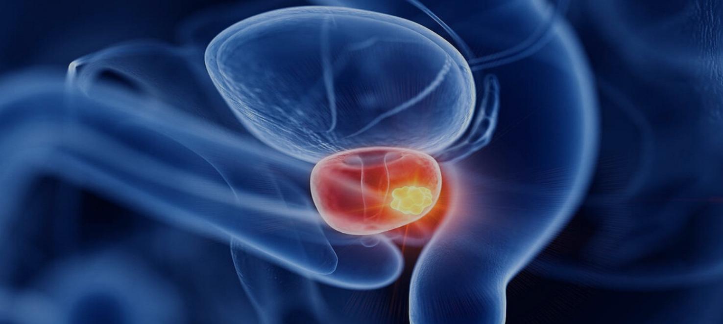 怎样有效预防前列腺癌发生,正确生活方式有助预防前列腺癌