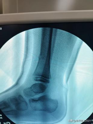 小孩被自行车撞康复要赔偿,孩子不小心被自行车撞了一下