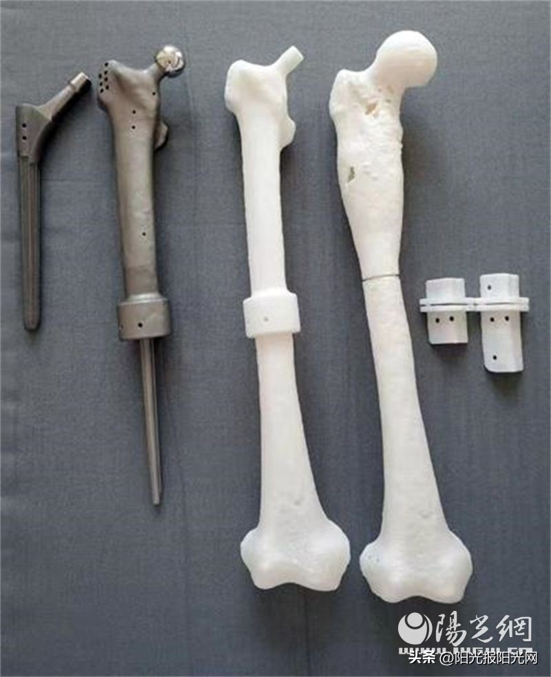 骨肉瘤3D打印假体,肿瘤型膝关节假体重建手术记录