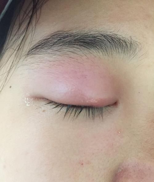 肾衰竭有这5个征兆和危险,肾衰竭一直不退烧是怎么回事