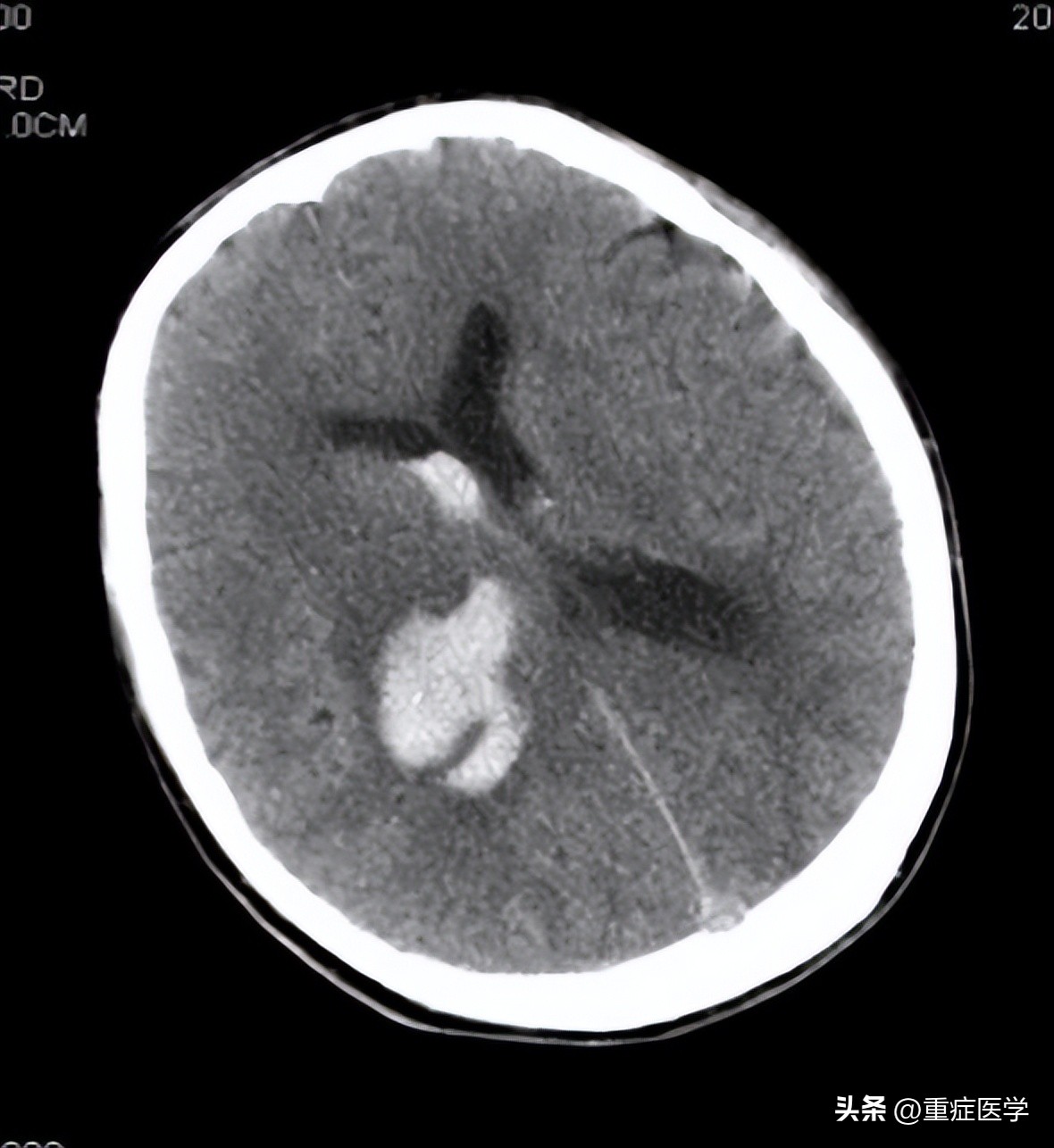 脑出血后缺钠,脑出血患者低钠血症病因