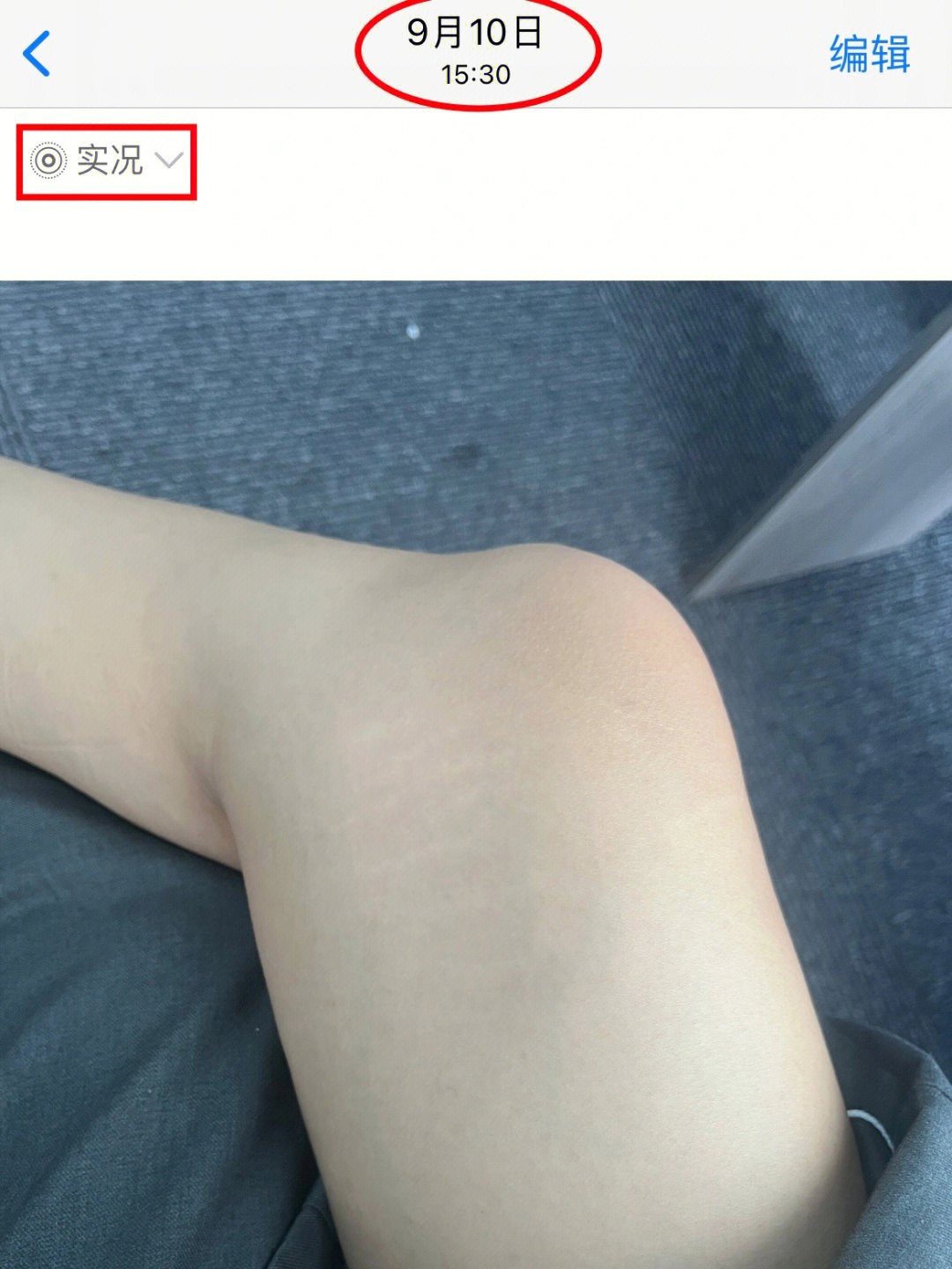 如何淡化腿上肥胖纹小窍门,腿上有肥胖纹怎么遮瑕