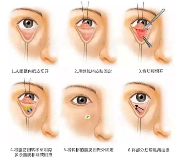 微整切眉去眼袋可以年轻多少岁,有几种快速去眼袋的方法