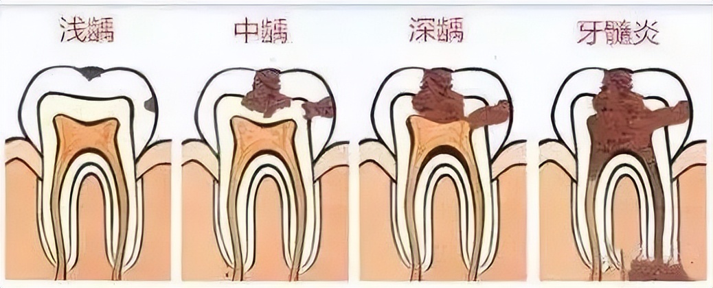 一颗牙齿补牙2600,年纪轻轻补牙补了六颗