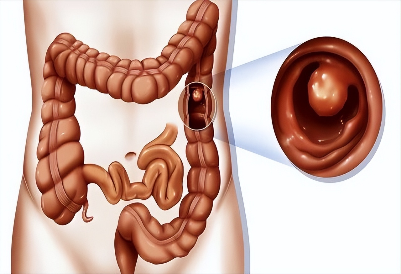 上厕所大便前硬后稀怎么回事,上厕所大便干硬怎么回事