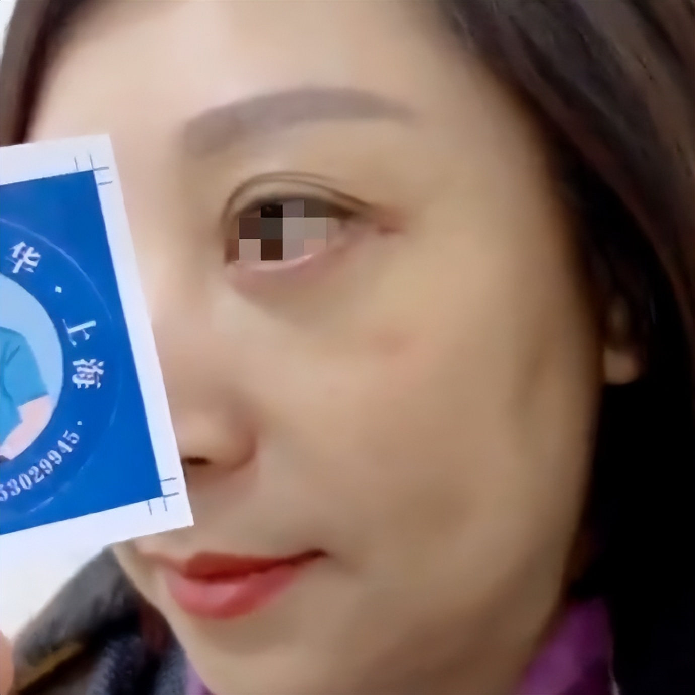 外切祛眼袋1-7天恢复图真人,外切祛眼袋恢复过程