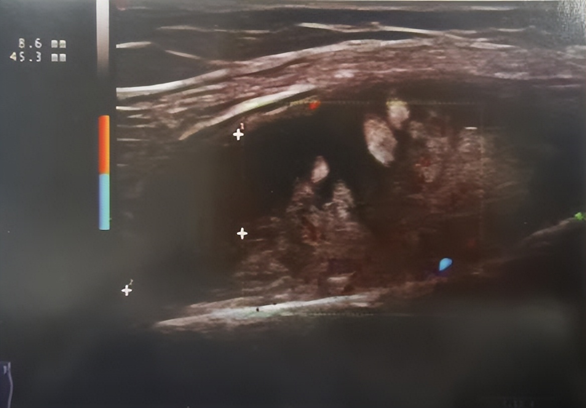 什么是肌骨超声为什么风湿病患者要做肌骨超声？