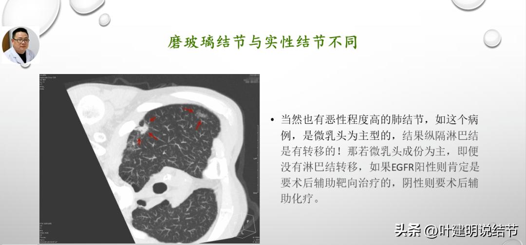非小细胞肺癌精准检测ppt,关于肺癌的ppt