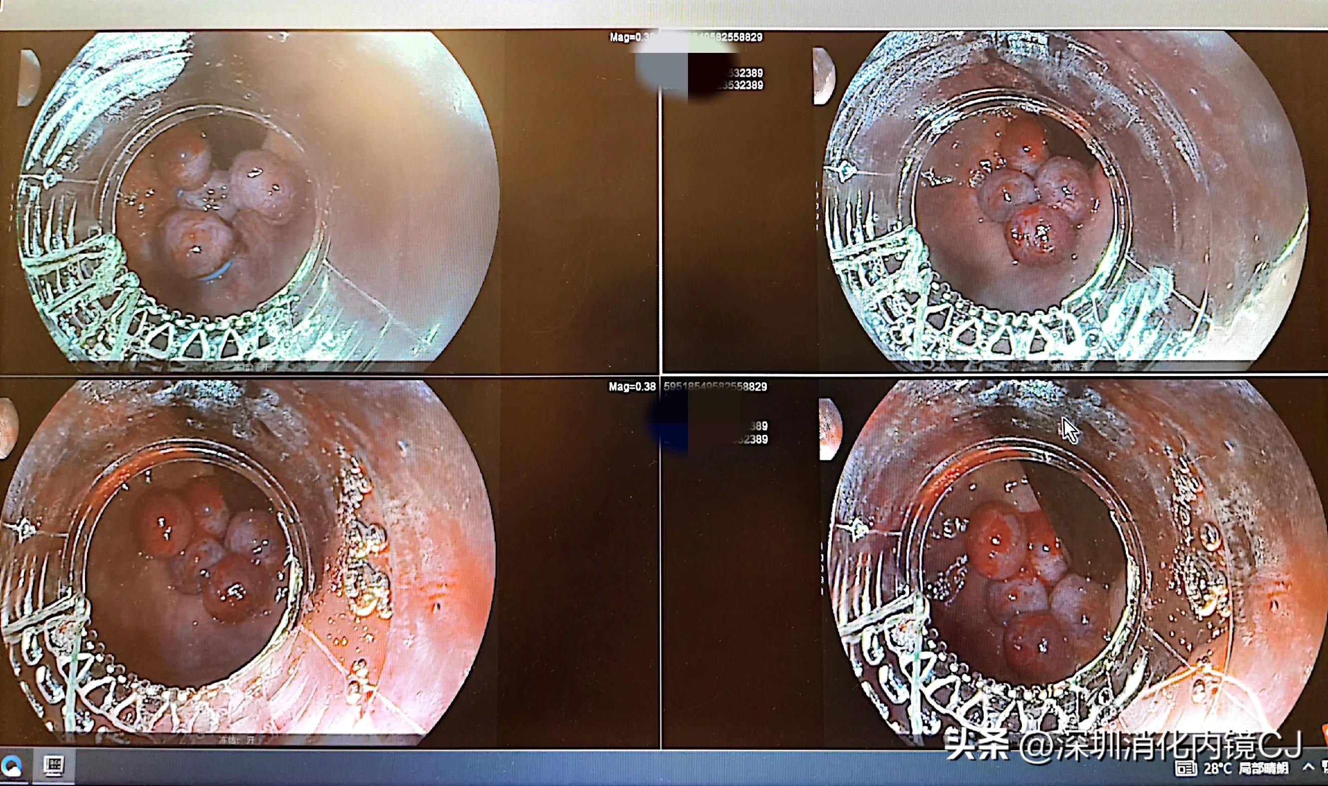 iii型痔疮,哪些痔疮患者适合内镜下套扎治疗