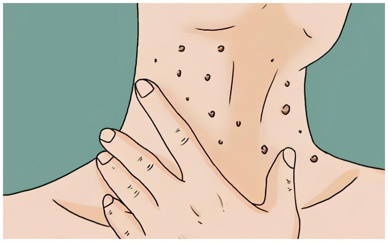 脖子上和腋下的小肉粒是什么原因,颈部和腋窝有小肉粒怎么消除