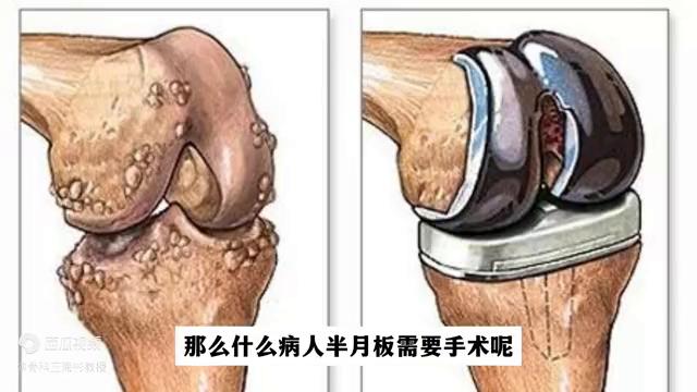 半月板损伤不做手术有什么好办法,半月板二度损伤静养三周变成三度