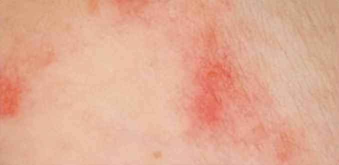 27岁应该检查tct还是hpv,女性查出hpv52感染需要夫妻同治吗