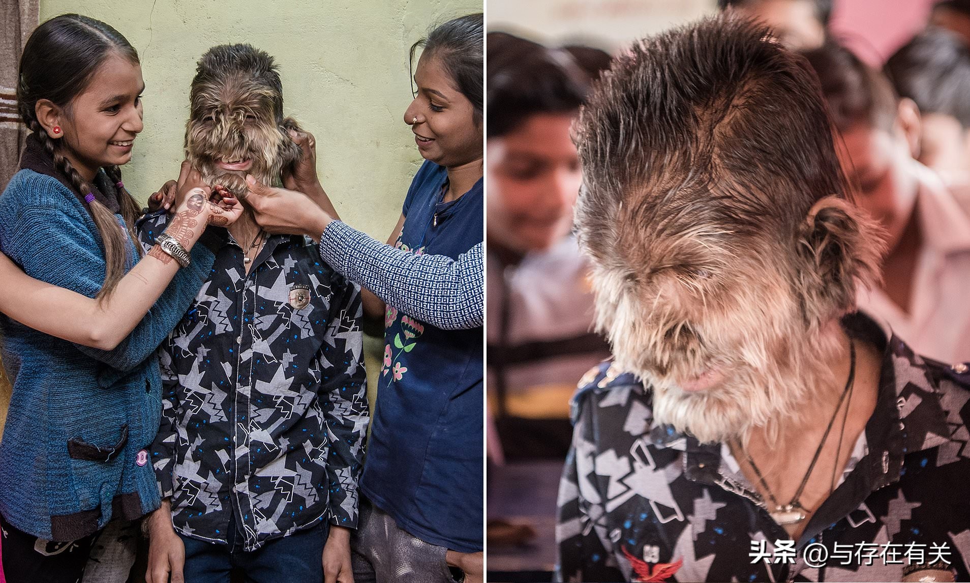 印度小伙患罕见疾病视频,印度8岁小孩长大后的奇闻异事