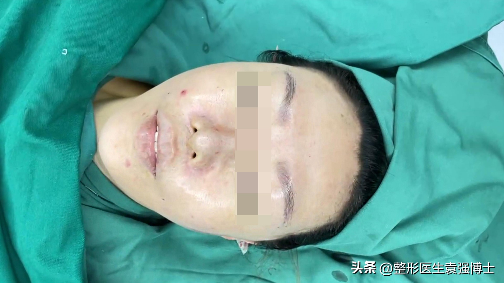 大拉皮术后一个脸大一个脸小,大拉皮后为什么一面脸大一面脸小