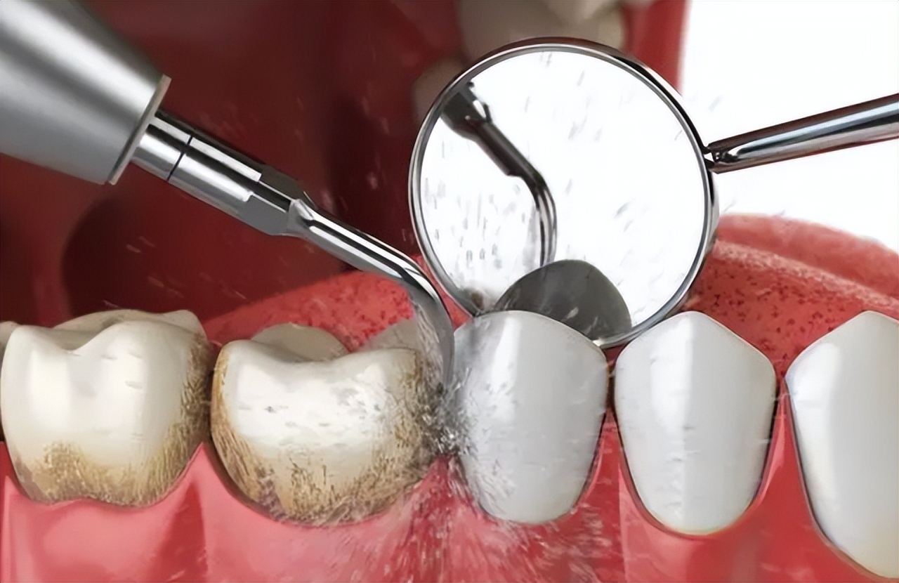 洗牙会伤害牙齿吗该不该洗牙,深度洗牙对牙齿有伤害吗