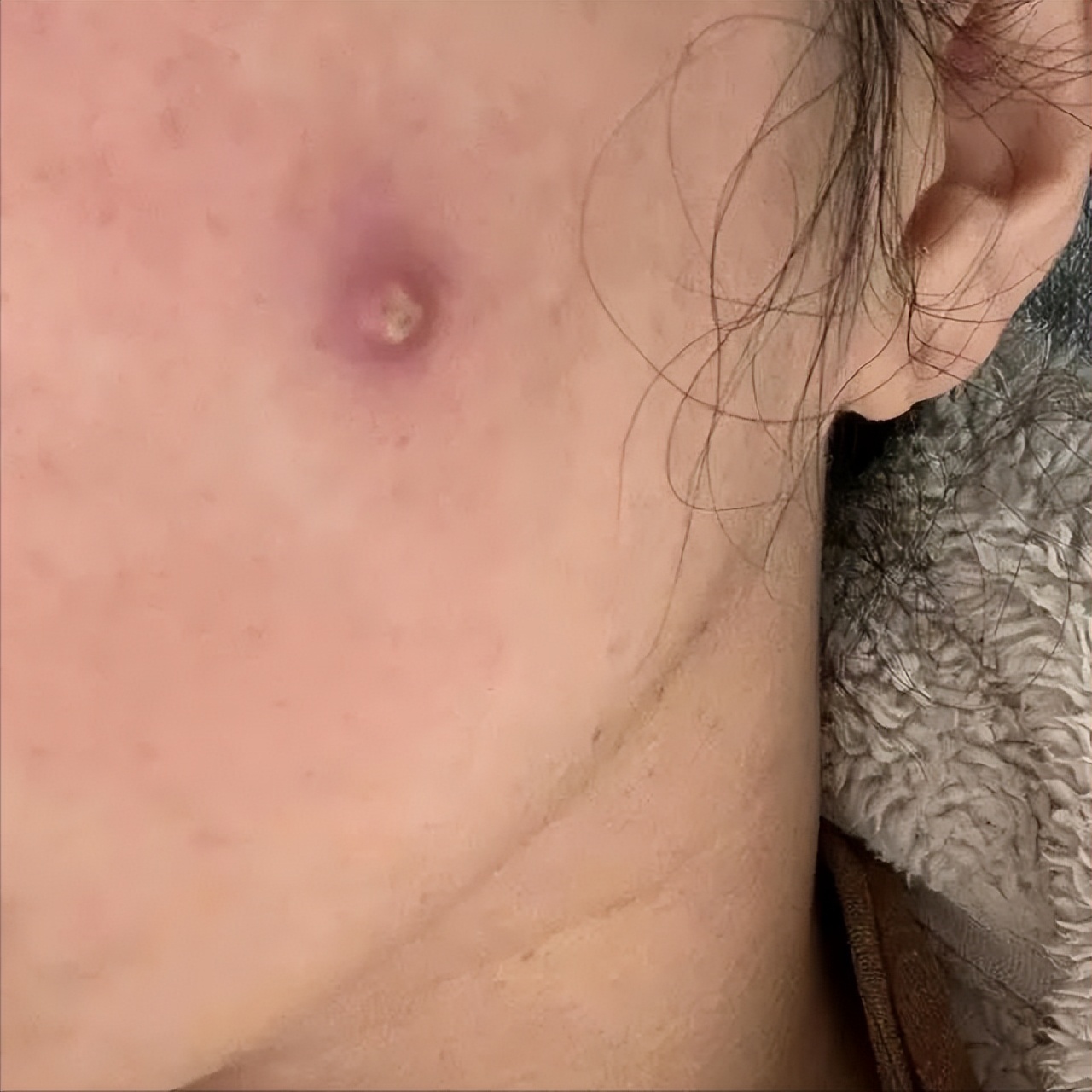 新冠后长了病毒疹,新冠阳性后皮肤长疹子