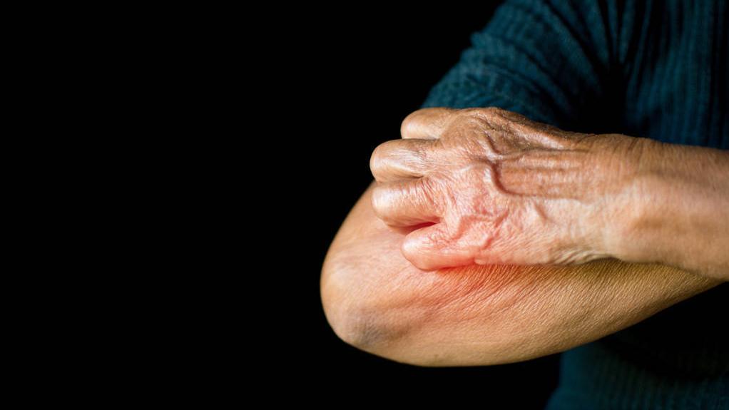 严重性荨麻疹和湿疹有什么好方法,湿疹和荨麻疹的治疗方法区别在哪