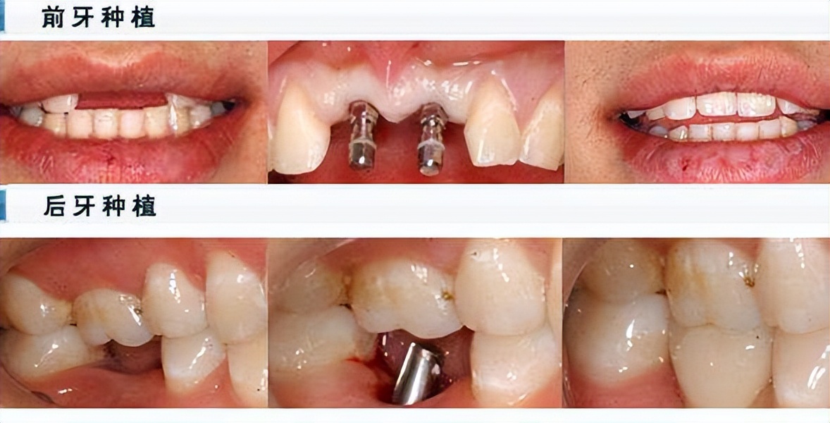 牙齿隐裂牙根完好可以保住么,牙齿蛀虫后只剩牙根要不要拔掉