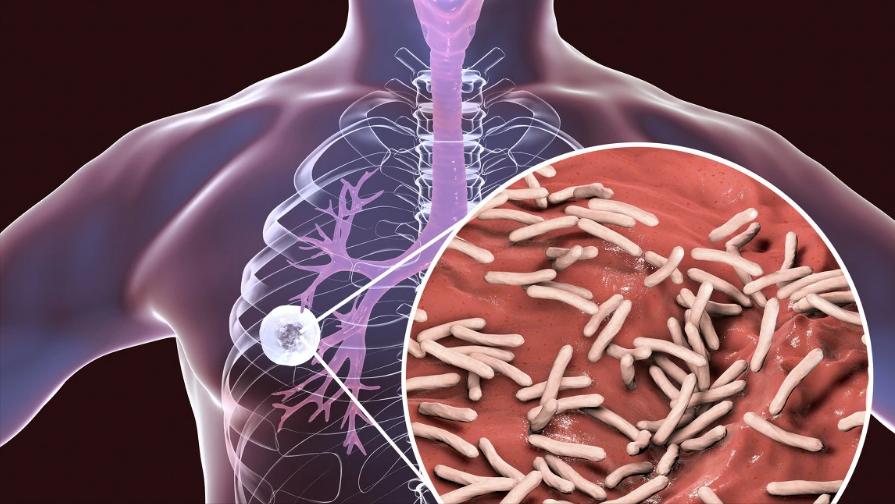 得了肺脓肿怎么办,肺脓肿怎么才能算彻底治愈