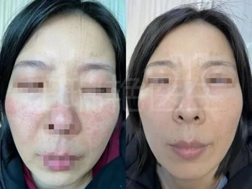 烂脸警告完整视频,烂脸警告