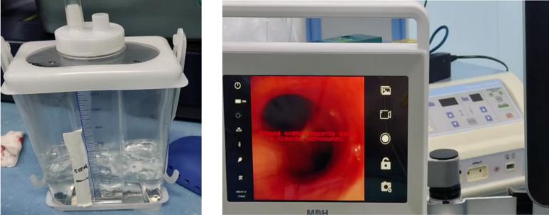 麻醉期间气道梗阻,手术后呼吸急促是什么原因