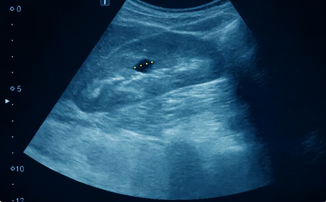 医生说囊肿是良性的但是需要手术,医生说是囊肿是什么意思