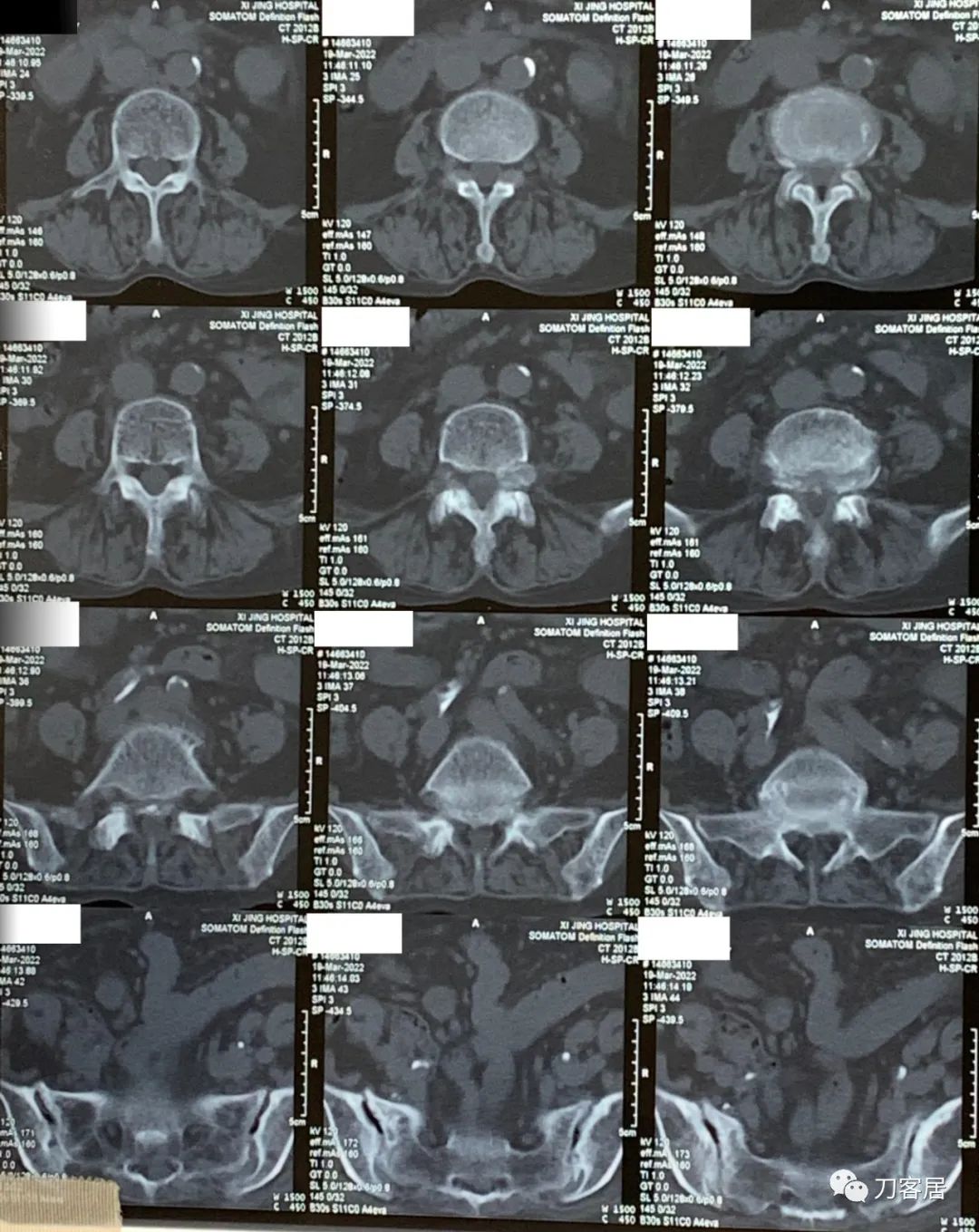 75岁老人腰间盘突出可以做手术吗,70岁老人腰间盘突出做手术