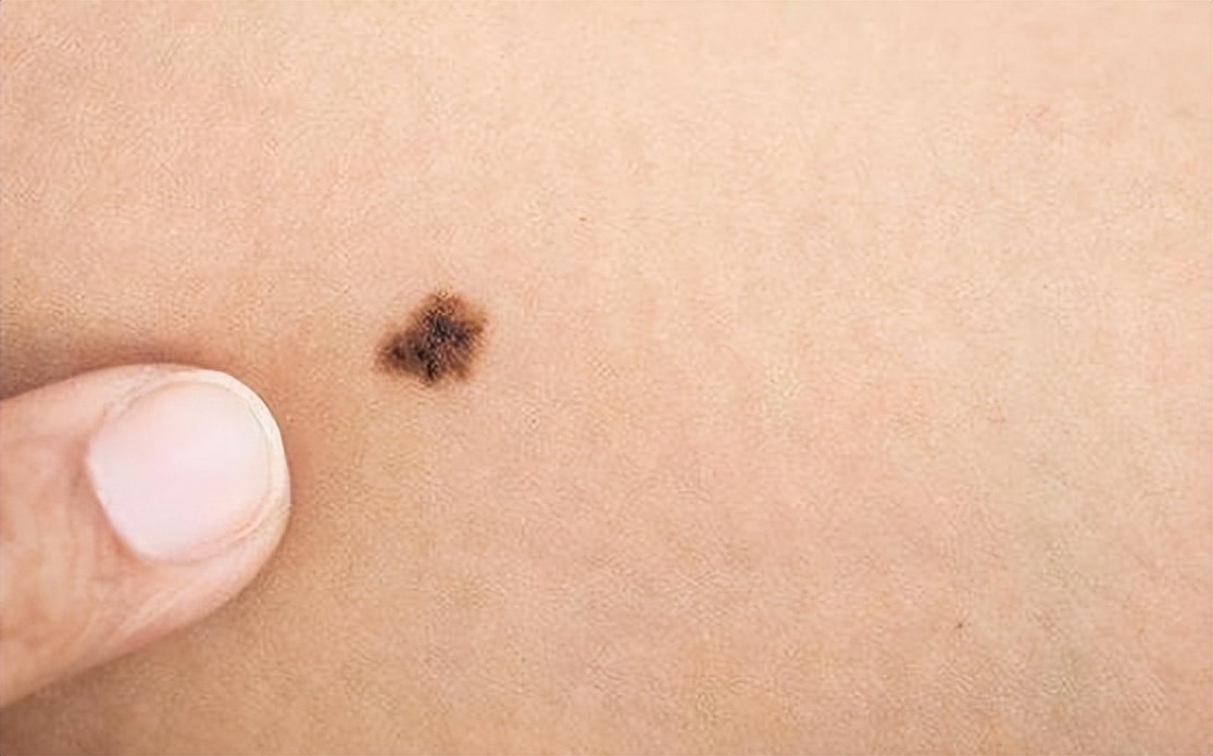 黑痣与肉痣长什么位置不能取,身上黑痣白痣红痣图片
