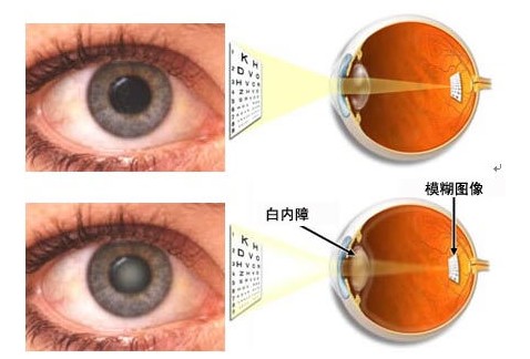 白内障眼药水排名前三,日本眼药水治疗白内障