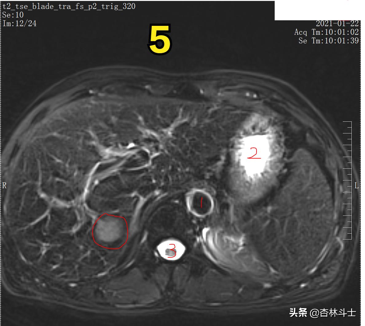 肝癌8公分肿瘤能活多久,肝癌细胞最大长多大