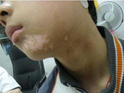 小孩子脸上长白斑需要吃打虫药吗,孩子脸上长斑是该打虫子了吗