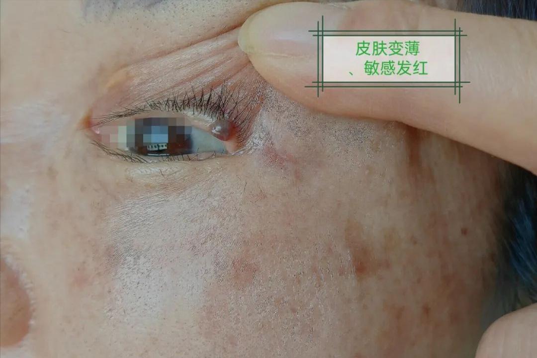 面部皮炎是炎症吗,脂溢性皮炎面部痒