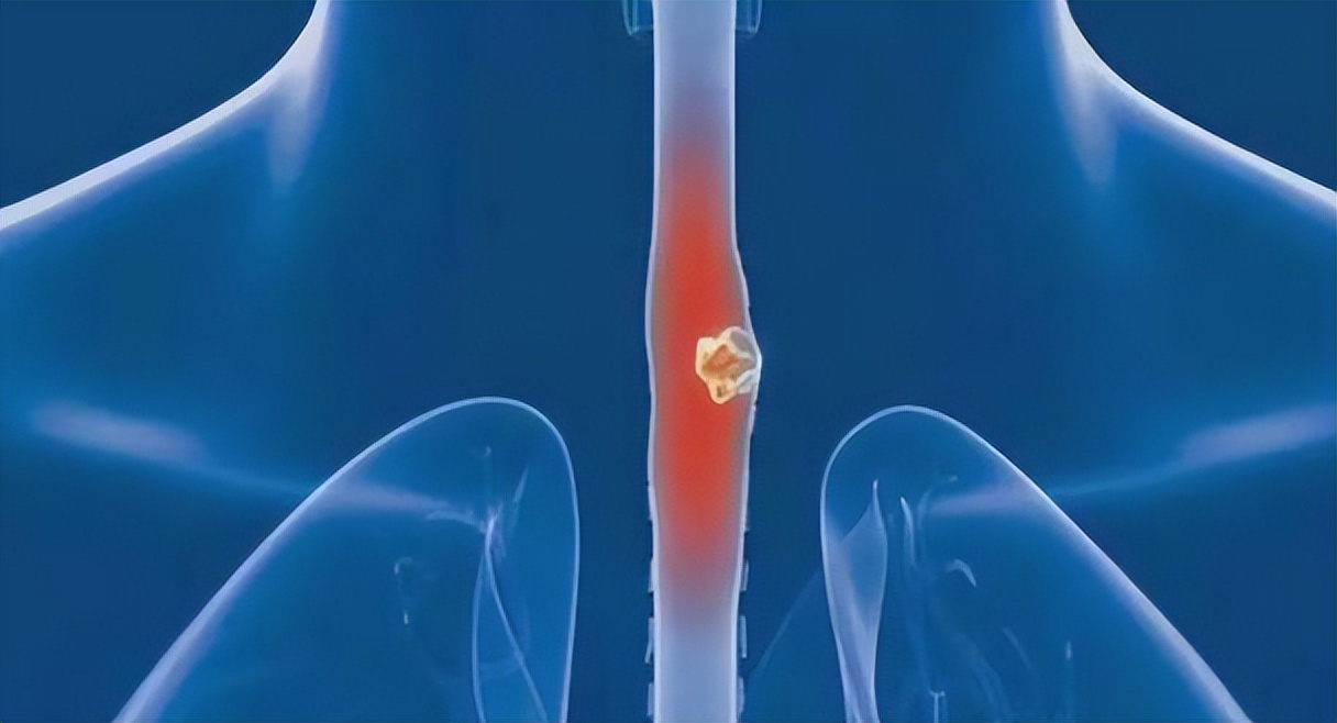 喉咙经常有炎症怎么回事,喉咙出现4个症状呼吸不畅