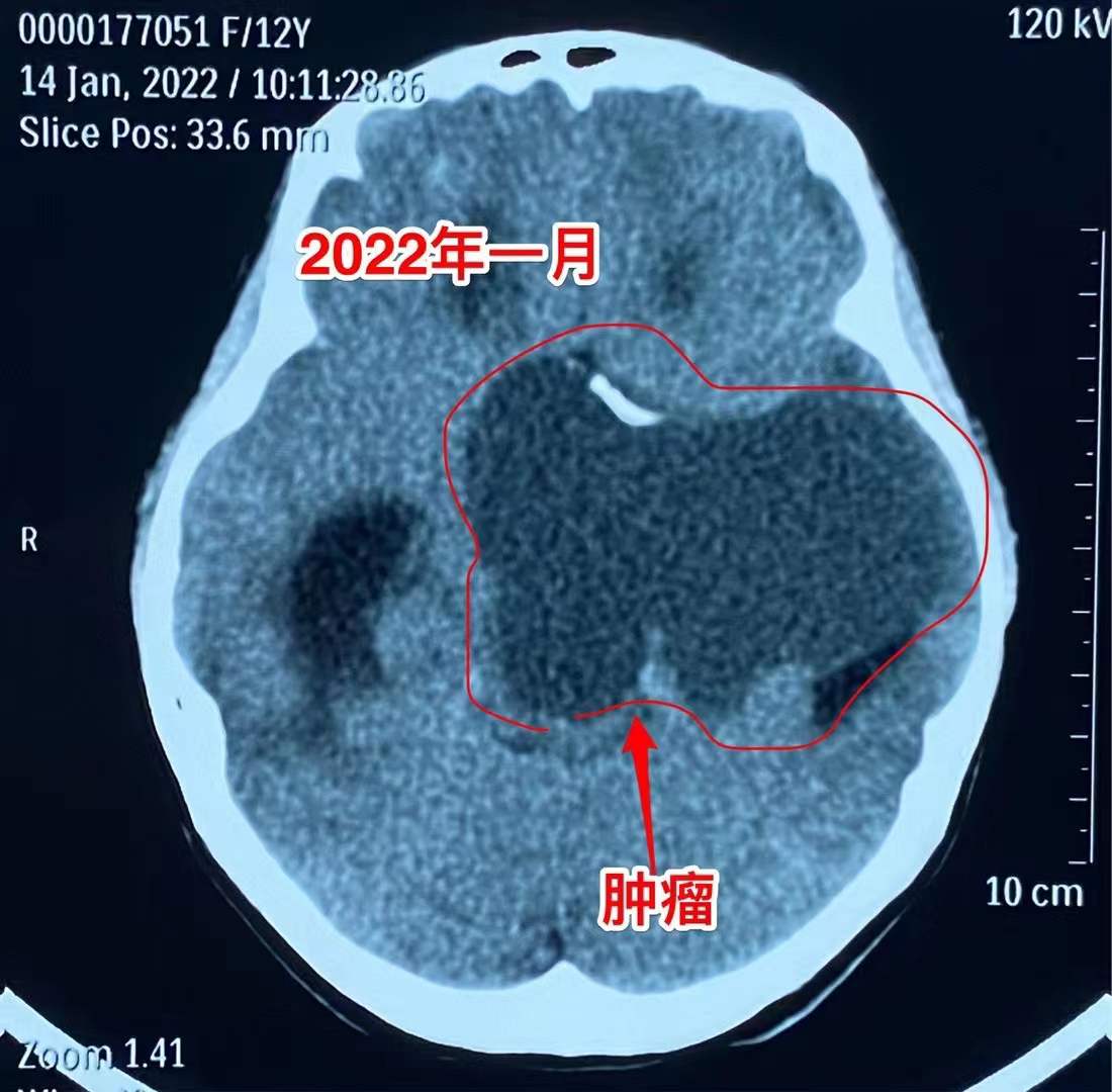误区！吃中药能控制颅咽管瘤！颅咽管瘤最有效的治疗是手术