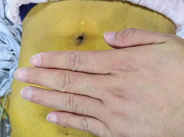 经常放屁是肝不好的表现视频,长期放屁多是肝不好的症状吗